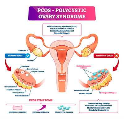 polycystic_ovary_syndrome_sm.jpg