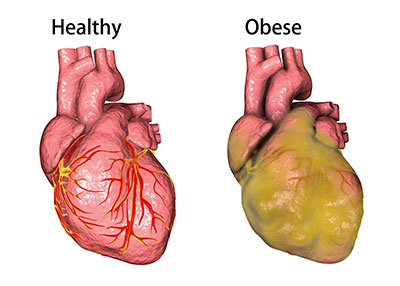 heart_disease_obesity_sm.png